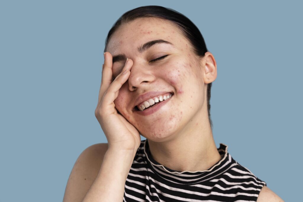 kandungan skincare kulit berjerawat